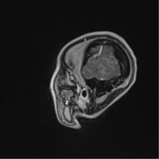 Cerebral abscess (Radiopaedia 60342-68009 J 9).png