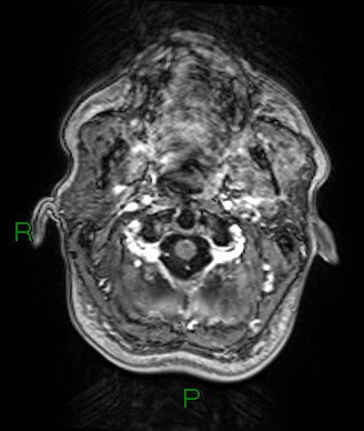 Cerebral abscess and subdural empyema (Radiopaedia 84436-99779 Axial T1 C+ 82).jpg