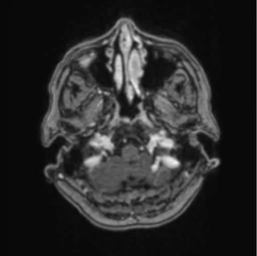 Cerebral abscess from pulmonary arteriovenous malformation (Radiopaedia 86275-102291 Axial T1 C+ 13).png