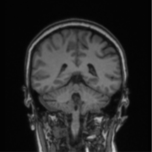 File:Cerebral abscess from pulmonary arteriovenous malformation (Radiopaedia 86275-102291 Coronal T1 34).png