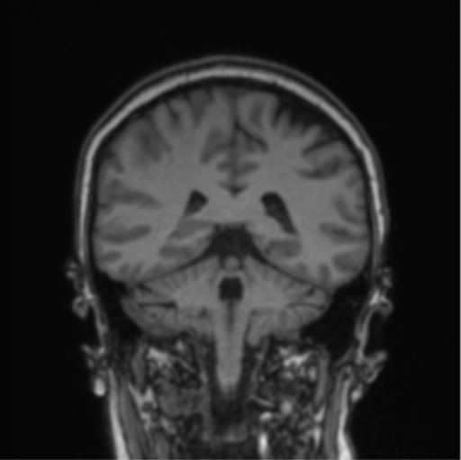 Cerebral abscess from pulmonary arteriovenous malformation (Radiopaedia 86275-102291 Coronal T1 35).png