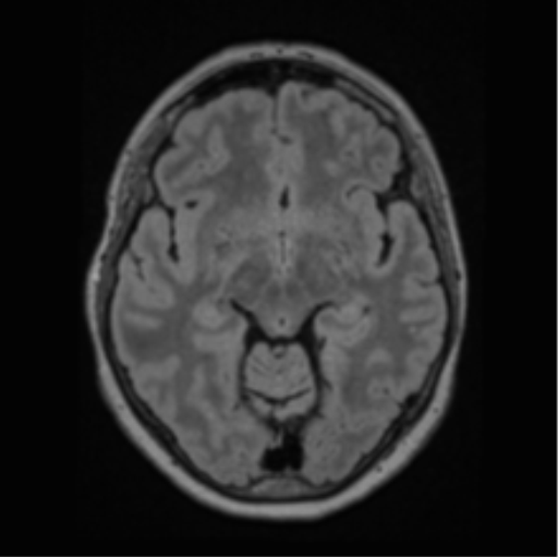 Cerebral abscess from pulmonary arteriovenous malformation (Radiopaedia 86275-102291 J 34).png