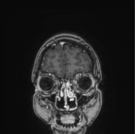 File:Cerebral abscess from pulmonary arteriovenous malformation (Radiopaedia 86275-102291 L 78).png