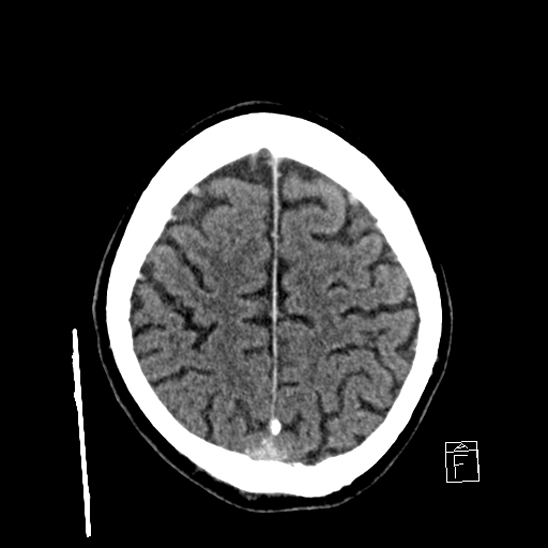 File:Cerebral abscess with ventriculitis (Radiopaedia 78965-91877 A 38).jpg