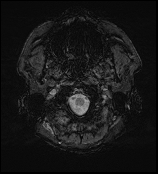 Cerebral abscess with ventriculitis (Radiopaedia 78965-91878 Axial SWI 5).jpg