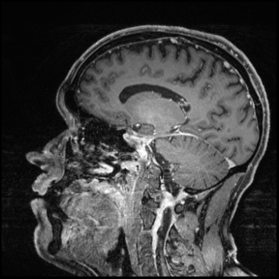Cerebral abscess with ventriculitis (Radiopaedia 78965-91878 Sagittal T1 C+ 107).jpg