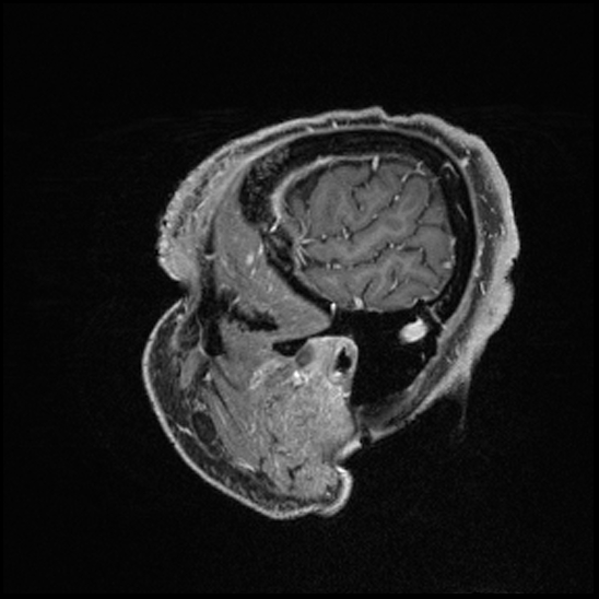 Cerebral abscess with ventriculitis (Radiopaedia 78965-91878 Sagittal T1 C+ 25).jpg