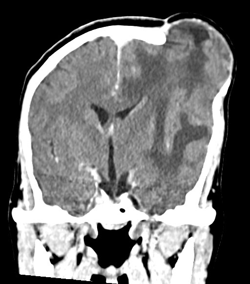 File:Cerebral abscesses (Radiopaedia 70458-80568 Coronal Contrast 31).jpg