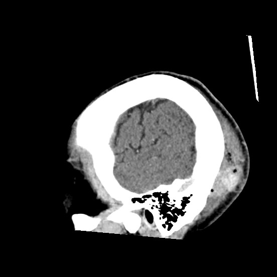 Cerebral amyloid angiopathy-related inflammation (Radiopaedia 74836-85848 C 53).jpg