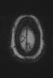File:Cerebral amyloid angiopathy (Radiopaedia 29129-29518 Axial SWI Magnitude 36).jpg