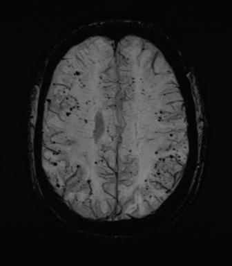 Cerebral amyloid angiopathy (Radiopaedia 46082-50433 Axial SWI MIP 55).png