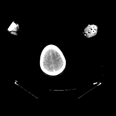 Cerebral and abdominal tuberculosis (Radiopaedia 90499-107853 D 4).jpg