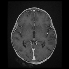 Cerebral and spinal tuberculosis (Radiopaedia 90489-107837 Axial T1 C+ 99).jpg