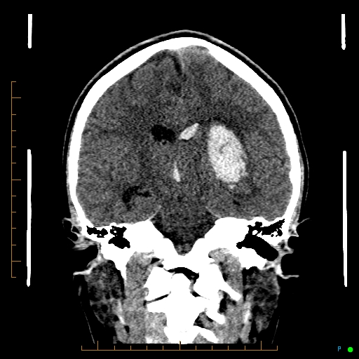 Cerebral arteriovenous malformation (AVM) (Radiopaedia 78162-90706 Coronal non-contrast 54).jpg