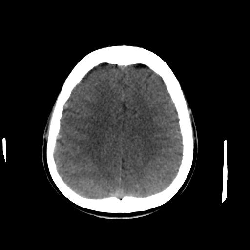 Cerebral arteriovenous malformation (Radiopaedia 28518-28759 Axial non-contrast 53).jpg