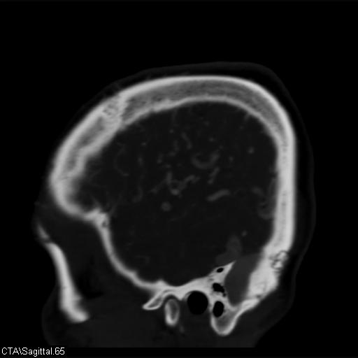 Cerebral arteriovenous malformation (Radiopaedia 28518-28759 D 62).jpg