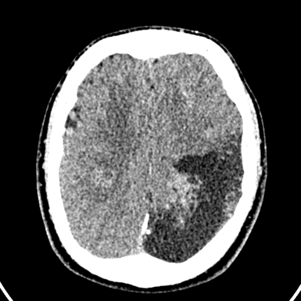 Cerebral arteriovenous malformation (Radiopaedia 37182-39012 Axial non-contrast 34).jpg