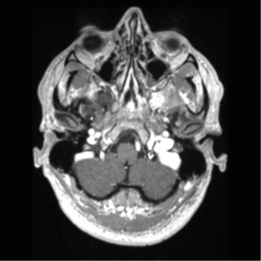 File:Cerebral arteriovenous malformation (Radiopaedia 39259-41506 AX T1 MPR C+ 10).png