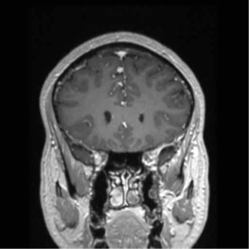 Cerebral arteriovenous malformation (Radiopaedia 39259-41506 Coronal T1 C+ 68).png