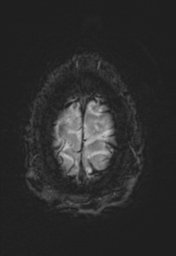 File:Cerebral arteriovenous malformation (Radiopaedia 55798-62372 Axial SWI 39).png