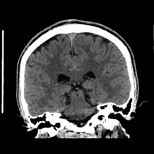 File:Cerebral arteriovenous malformation (Radiopaedia 61964-70028 Coronal non-contrast 37).jpg
