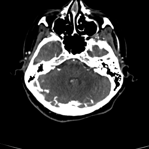 Cerebral arteriovenous malformation (Radiopaedia 73830-84645 Axial C+ delayed 70).jpg