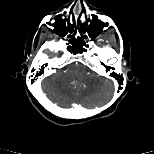 Cerebral arteriovenous malformation (Radiopaedia 73830-84645 Axial C+ delayed 72).jpg