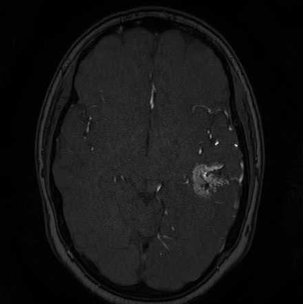 Cerebral arteriovenous malformation (Radiopaedia 74411-85654 Axial MRA 62).jpg
