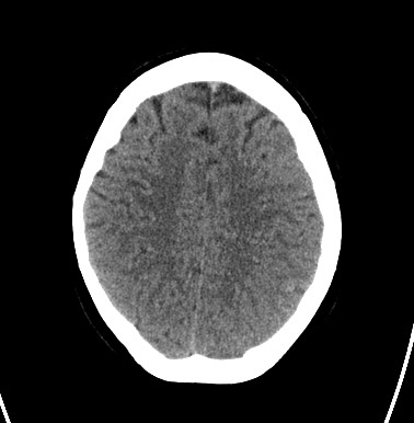 File:Cerebral arteriovenous malformation (Radiopaedia 74411-85744 Axial non-contrast 26).jpg