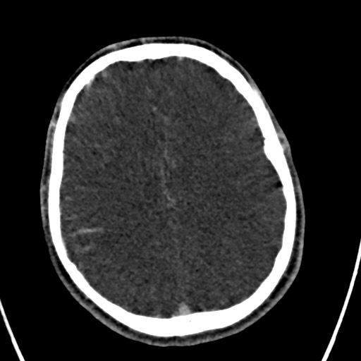 Cerebral arteriovenous malformation (Radiopaedia 78188-90746 Axial C+ delayed 116).jpg