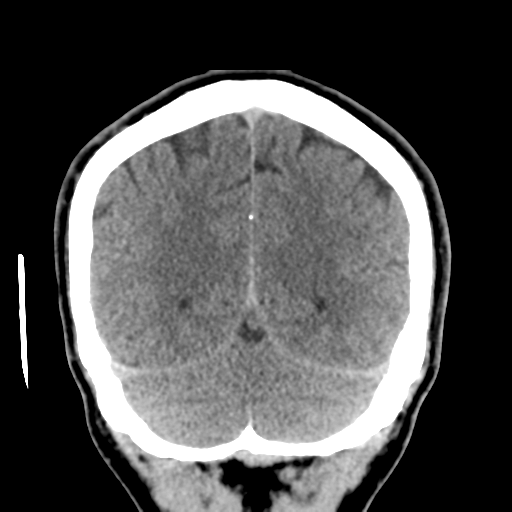 Cerebral arteriovenous malformation (Spetzler-Martin grade 2) (Radiopaedia 41262-44076 Coronal non-contrast 50).png