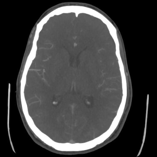 Cerebral arteriovenous malformation (Spetzler-Martin grade 2) (Radiopaedia 41262-44076 E 29).png