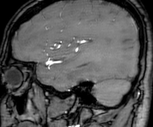 Cerebral arteriovenous malformation at posterior body of corpus callosum (Radiopaedia 74111-84925 J 78).jpg