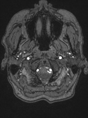 Cerebral arteriovenous malformation with hemorrhage (Radiopaedia 34422-35737 Axial MRA 1).png