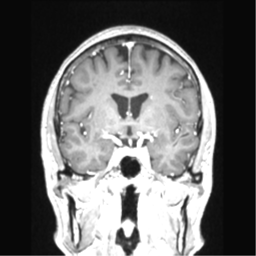 Cerebral arteriovenous malformation with hemorrhage (Radiopaedia 34422-35737 Coronal T1 C+ 55).png