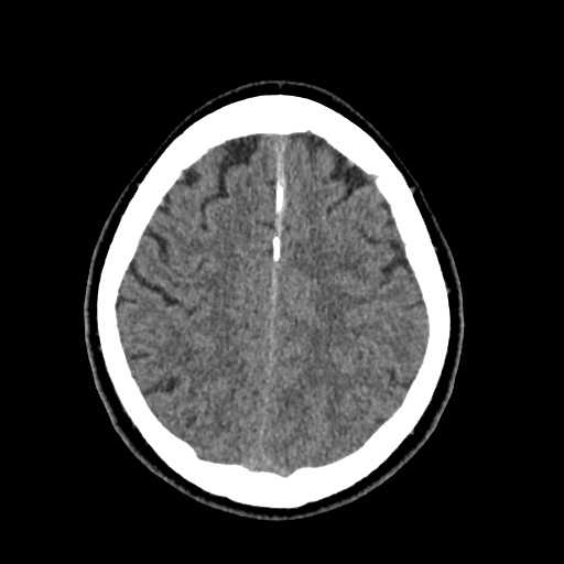 Cerebral arteriovenous malformation with lobar hemorrhage (Radiopaedia 35598-37117 Axial non-contrast 43).jpg