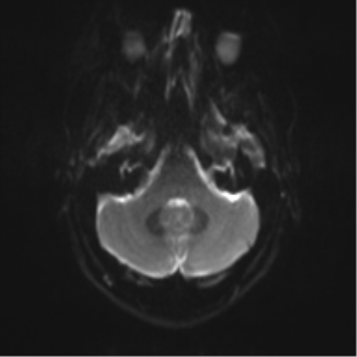 File:Cerebral cavernoma and development venous anomaly (Radiopaedia 37603-39482 Axial DWI 6).png