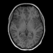 File:Cerebral cavernous venous malformation (Radiopaedia 70008-80021 Axial T1 36).jpg