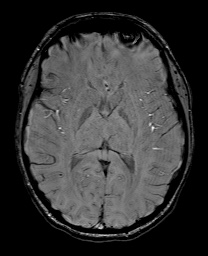 Cerebral cavernous venous malformation (Radiopaedia 70008-80021 I 38).jpg