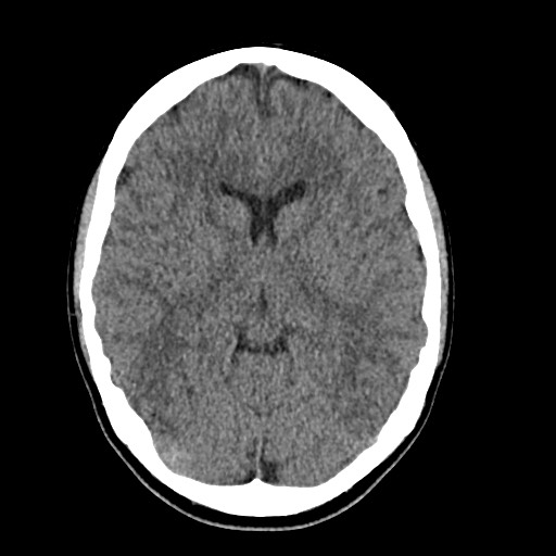 Cerebral cavernous venous malformation (Radiopaedia 70008-80022 Axial non-contrast 23).jpg