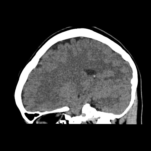 File:Cerebral cavernous venous malformation (Radiopaedia 70008-80022 C 37).jpg