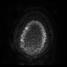 Cerebral cavernous venous malformation (Zabramski type II) (Radiopaedia 85511-101198 Axial DWI 64).jpg