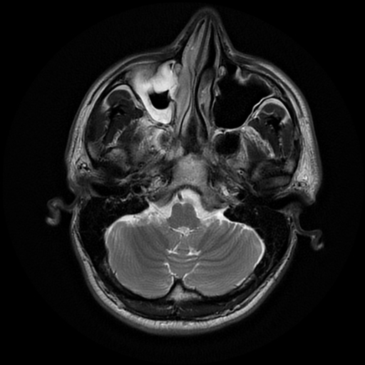 File:Cerebral cavernous venous malformation (Zabramski type II) (Radiopaedia 85511-101198 Axial T2 7).jpg