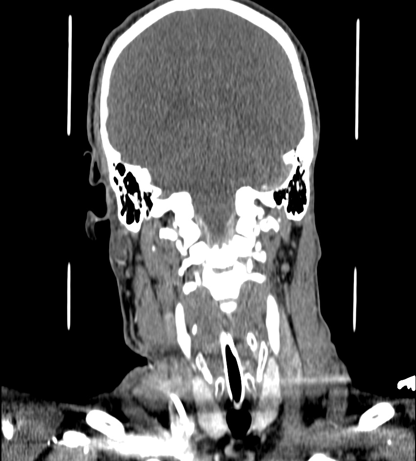 Cerebral edema in an overdose patient (Radiopaedia 72005-82539 B 93).jpg