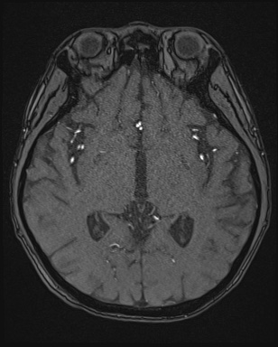 Cerebral embolic infarcts (embolic shower) (Radiopaedia 72391-82921 Axial MRA 82).jpg