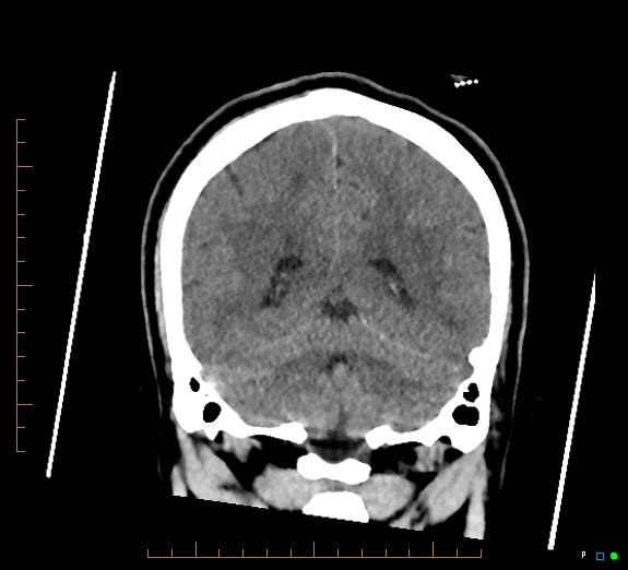 Cerebral fat embolism (Radiopaedia 85521-101220 Coronal non-contrast 44).jpg