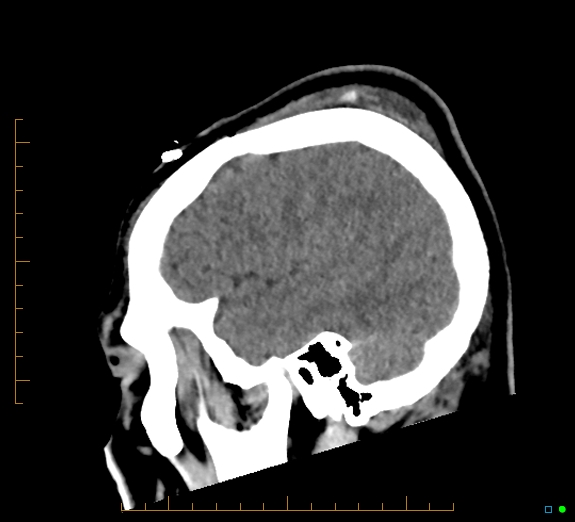 Cerebral fat embolism (Radiopaedia 85521-101224 C 42).jpg