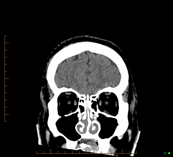 Cerebral fat embolism (Radiopaedia 85521-101224 Coronal non-contrast 14).jpg