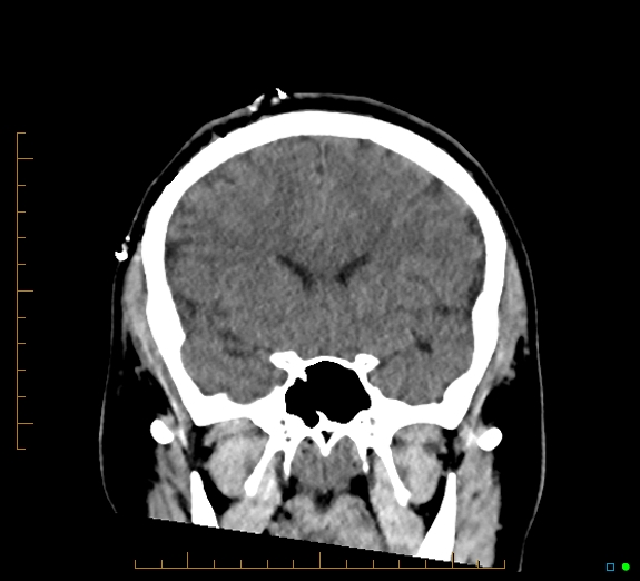 Cerebral fat embolism (Radiopaedia 85521-101224 Coronal non-contrast 24).jpg