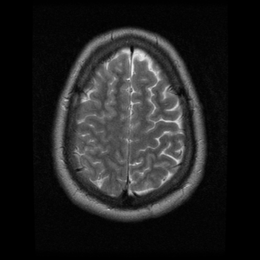 File:Cerebral hemorrhage secondary to arteriovenous malformation (Radiopaedia 33497-34572 Axial T2 20).png
